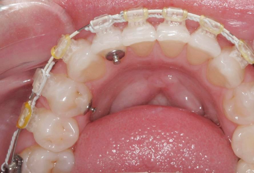 Level 2 Tip Powerchain Slingshot